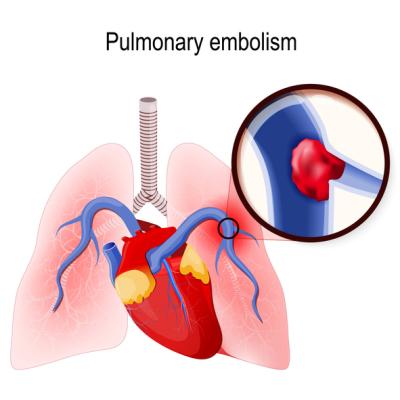 pulmonary embolism graphic